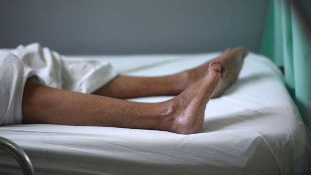 Las piernas de una paciente que padece el síndrome de Guillain-Barré en Brasil